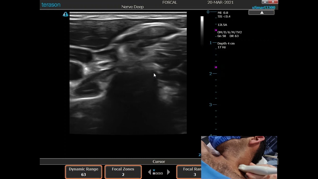 Escaneo Plexo Braquial a nivel Supraclavicular.