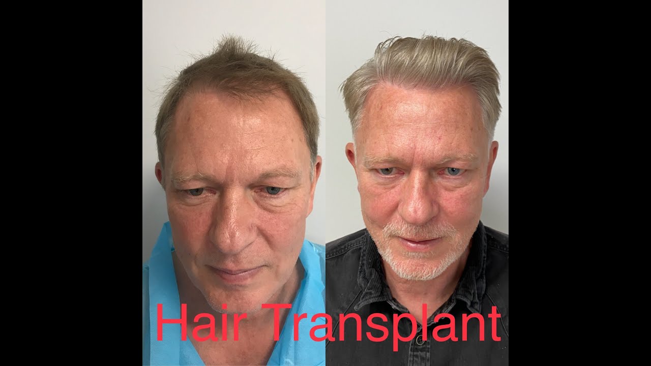 hair transplant results after two years Conor Mullen. FUE + FUT