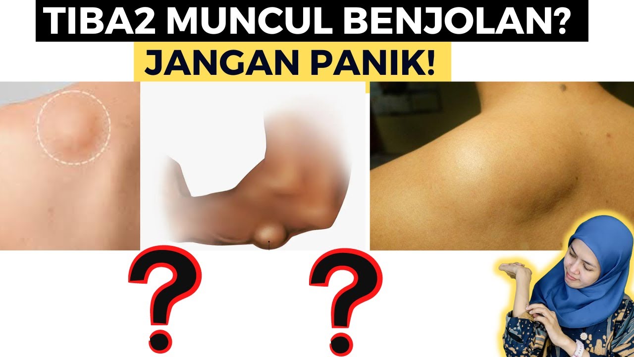 MUNCUL BENJOLAN ANEH DI TUBUH (Kupas Tuntas Penyakit Lipoma)