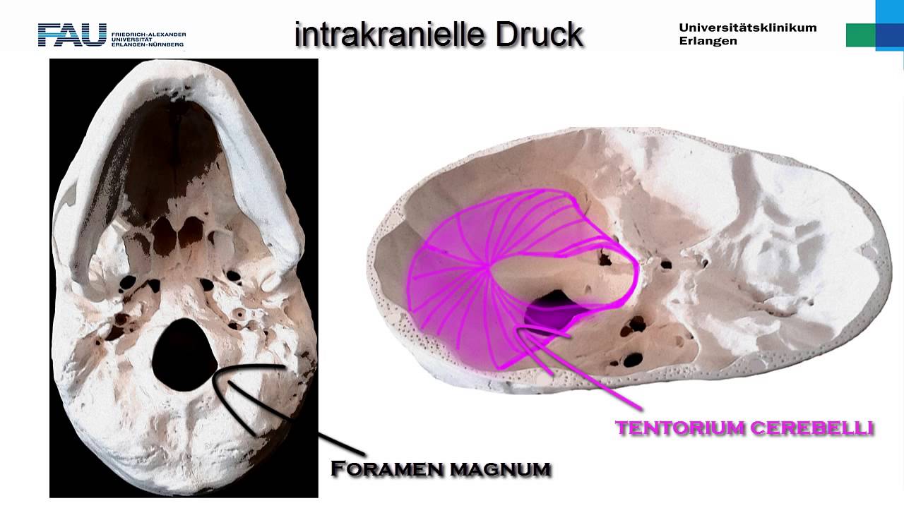 Neurologie ─ Intrakranieller Druck