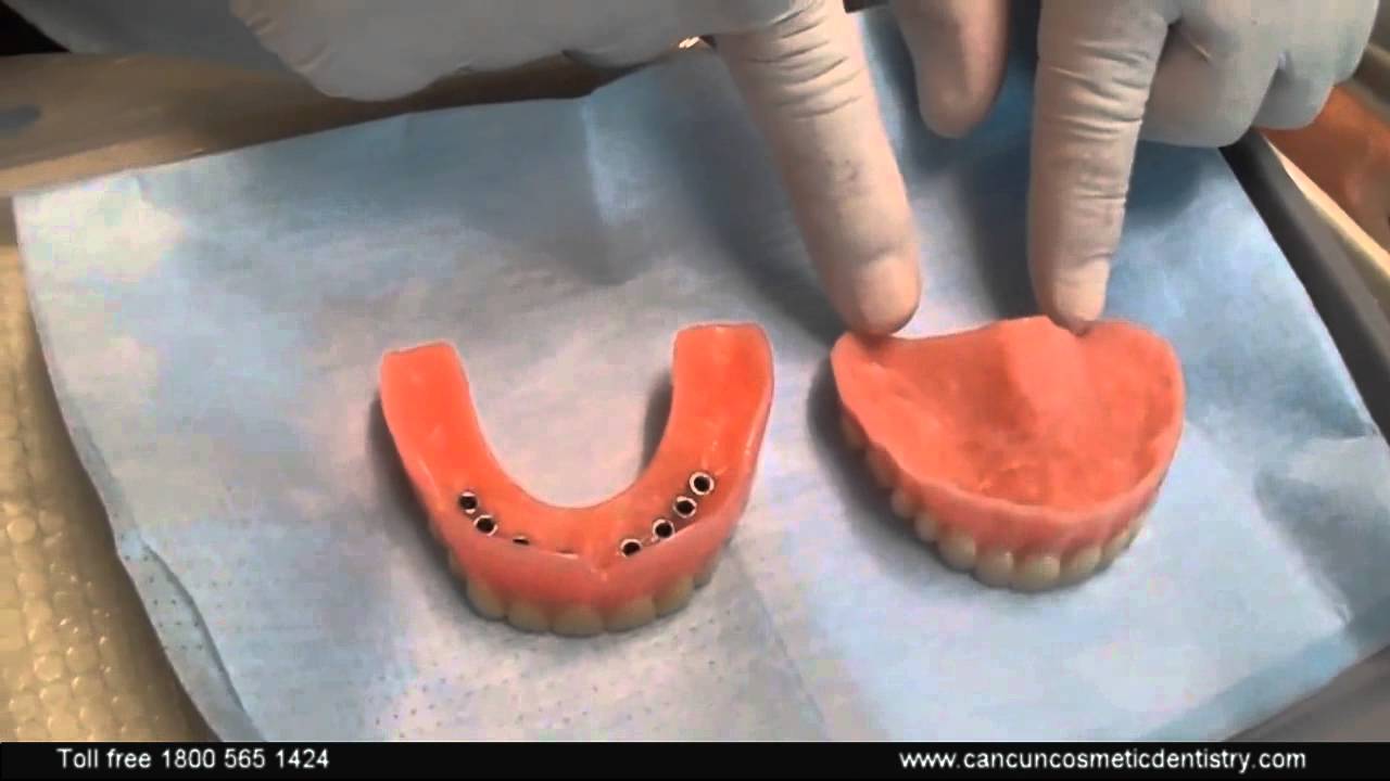 𝐒𝐧𝐚𝐩 𝐢𝐧 𝐃𝐞𝐧𝐭𝐮𝐫𝐞𝐬 𝐢𝐧 𝐌𝐞𝐱𝐢𝐜𝐨 with dental implants testimonial review | See how he got an amazing smile