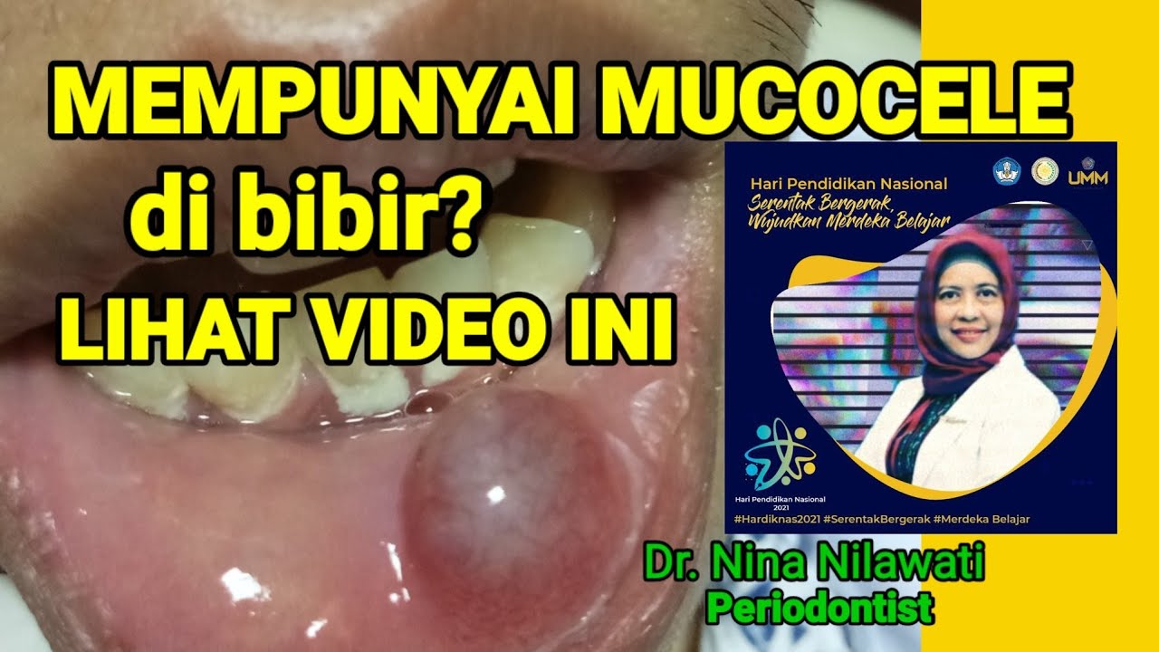 Seputar Mucocele