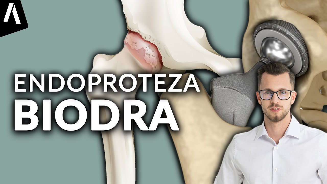 Endoproteza stawu biodrowego I Czy jest KONIECZNA dla Twoich bioder? I Fizjomate