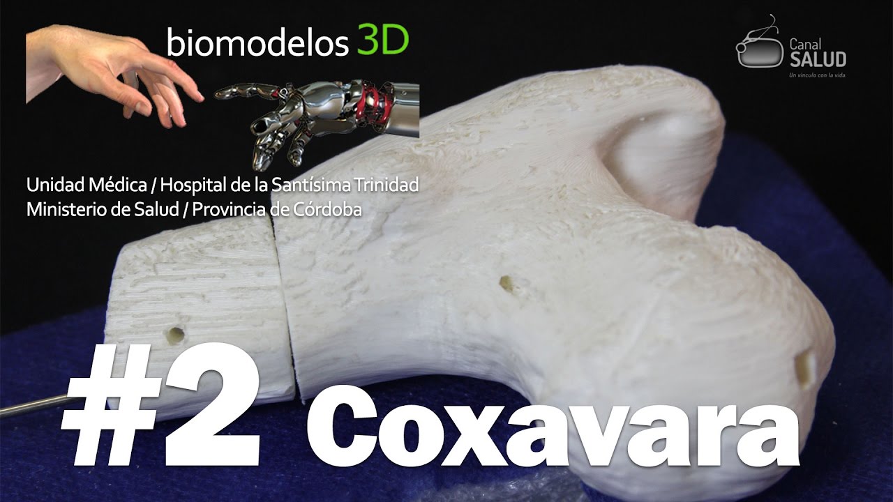 Coxavara - Secuela de enfermedad de Perthes con cirugía previa.