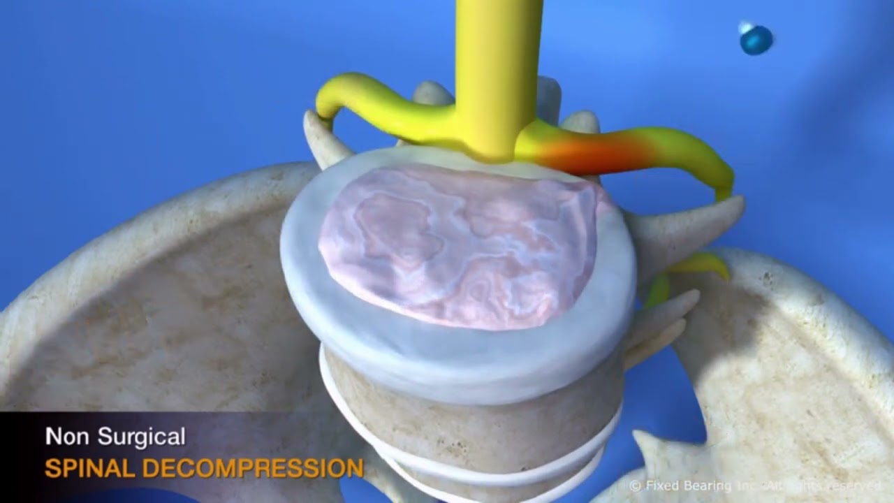 Non Surgical Spinal Decompression is explained by Dr. Mark Dailey of Oneonta Spine and Laser.