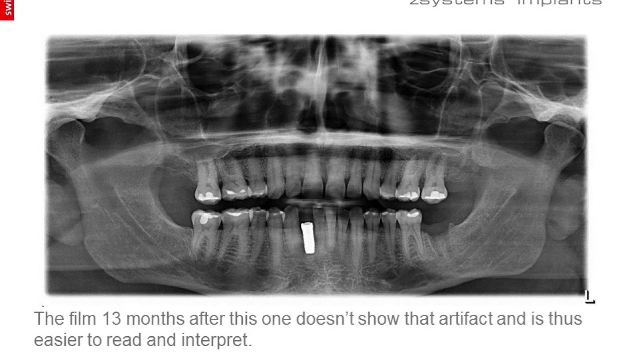 Z5c: Tooth #26 + 1 year post-treatment photos