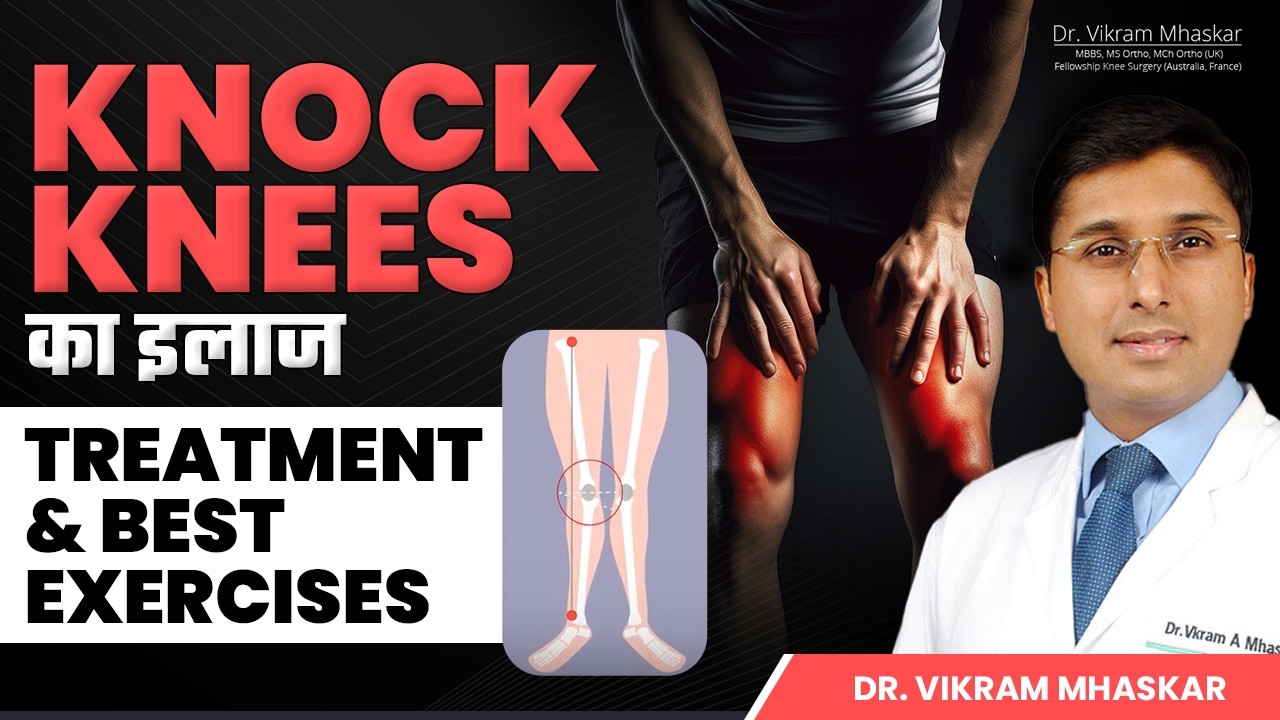 क्या Knock Knees का इलाज Possible है ? Knock Knees के लिए Effective Exercises | Dr Vikram Mhaskar