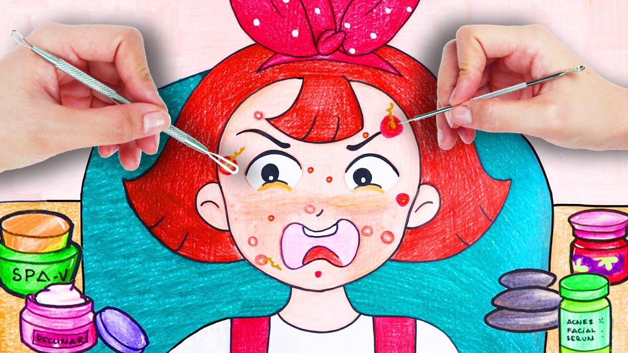 Acne Face Treatment - 여드름 얼굴 치료 || Seegi Paper || 종이시기 || Stop Motion