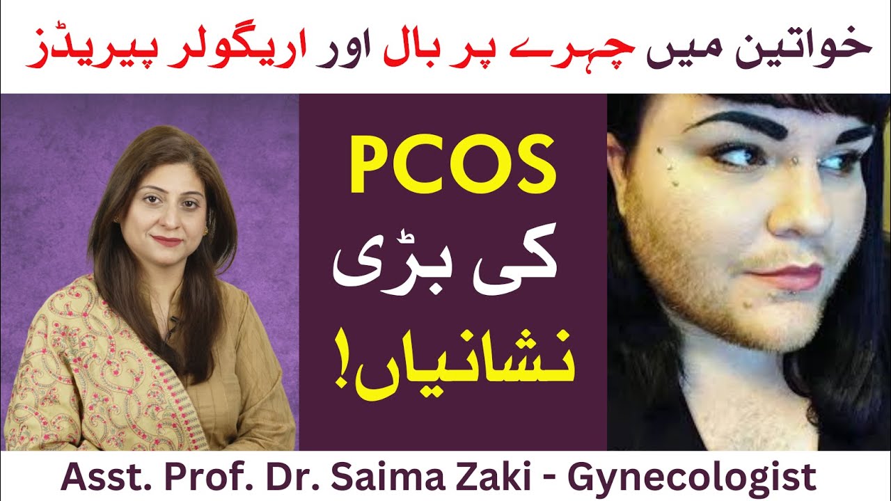 PCOS Symptoms & Treatment |  PCOS ka Ilaj (Urdu/Hindi)