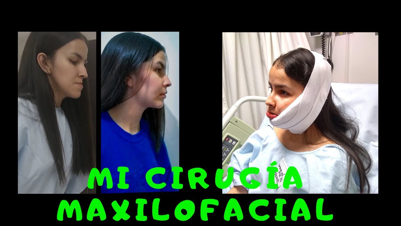 Mi cirugía maxilofacial/minivlog + experiencia - Life Valeria