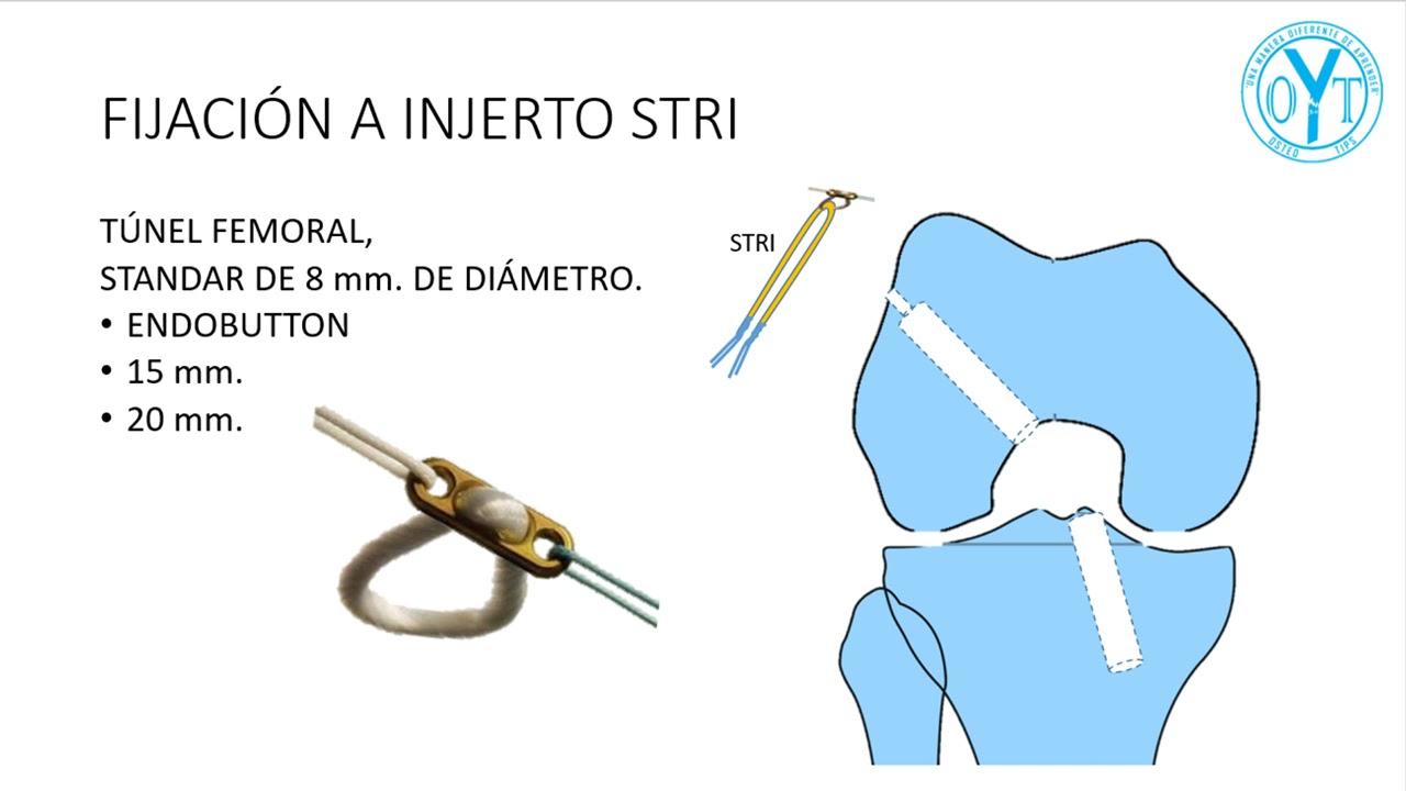 Qué tipo de Fijación del injerto utilizar, en reconstrucción de LCA?