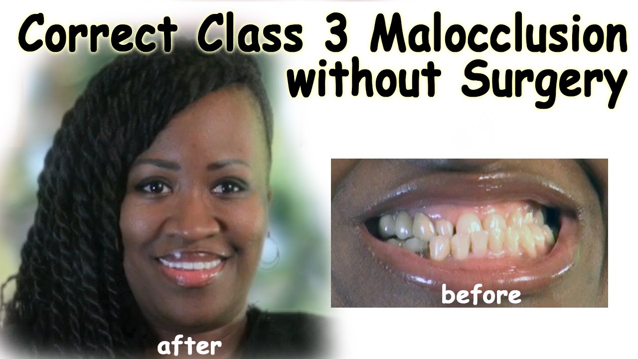 Correct Class 3 Malocclusion without Surgery - Bergen County NJ Dentist