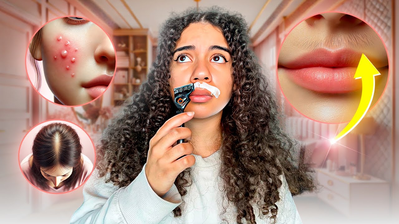 SOPK | Comment diminuer l'hyperandrogénie (hirsutisme, acné, perte de cheveux...) - Les 6 point clés