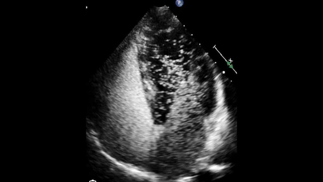 Bubble study in echocardiography, intra vs extra cardiac shunts in bubble study