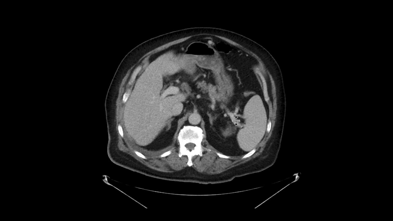 Pancreatic adenocarcinoma