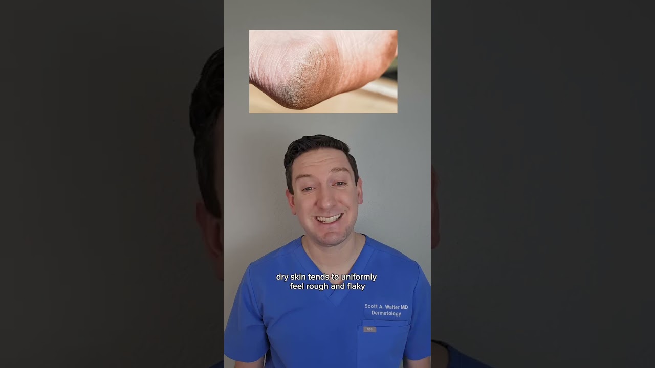 Just dry skin or fungus? Here's 3 clues to tell if you have a fungal infection! #dryfeet #footfungus