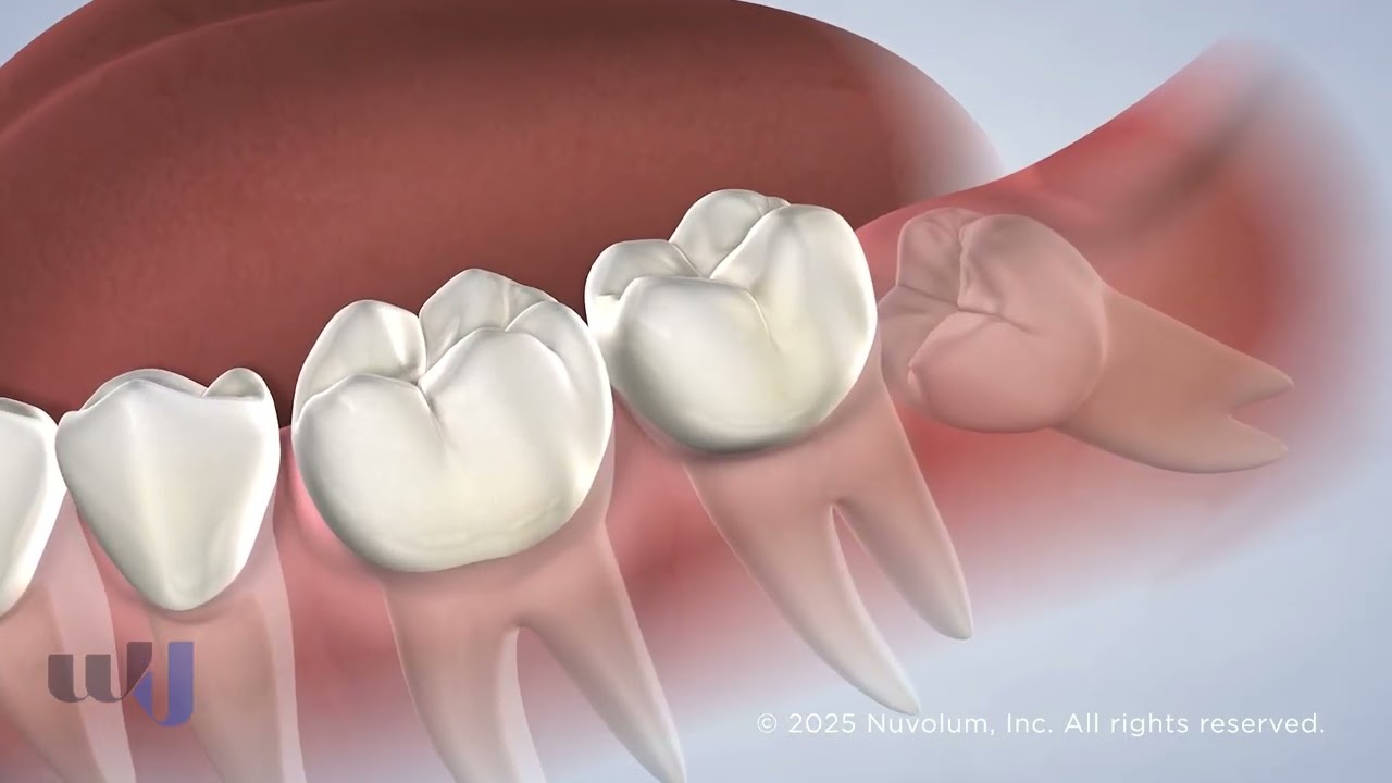 Wisdom Teeth Removal at West Jersey Oral & Dental Implant Surgery