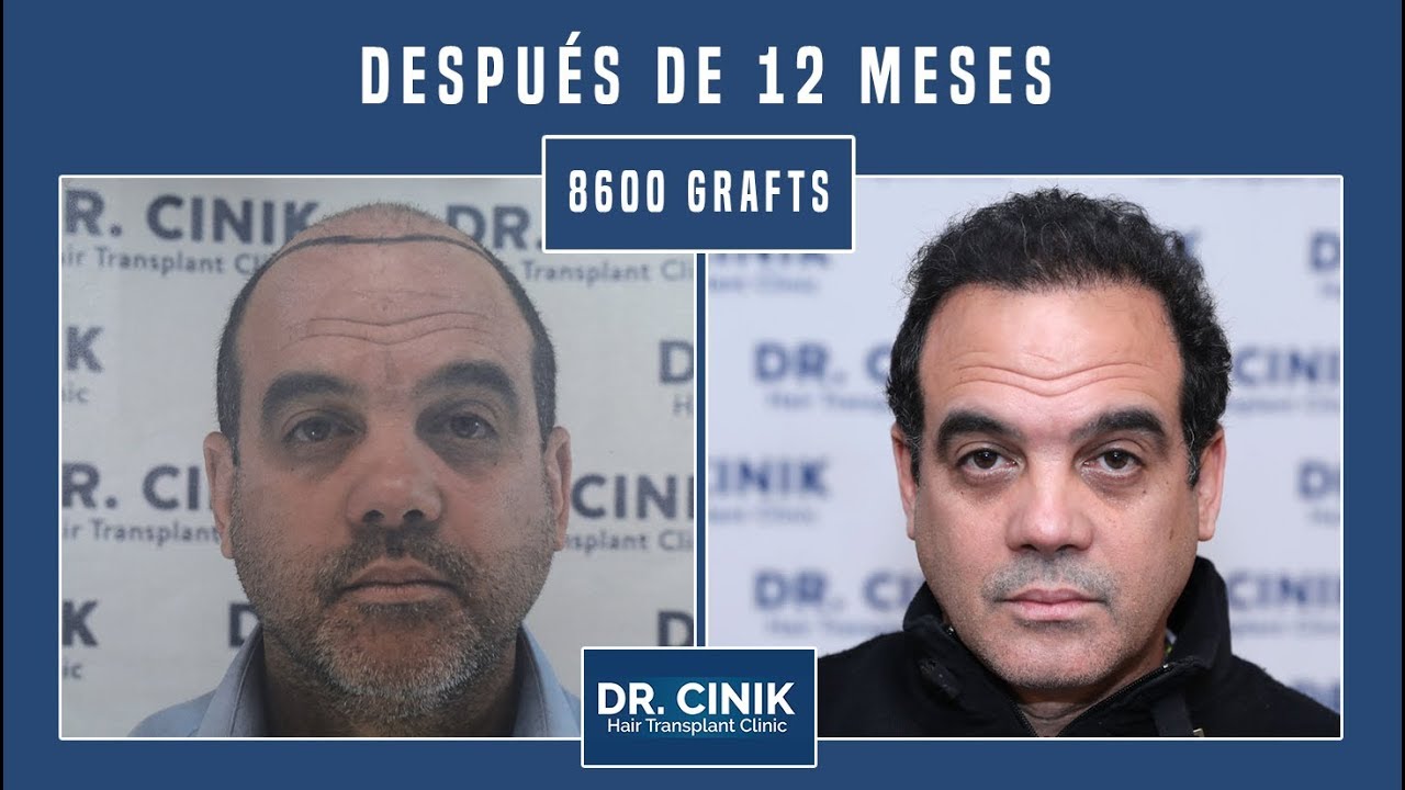 Dr. Cinik Clínica de trasplante capilar | Hair Transplant | Dr. Emrah Cinik