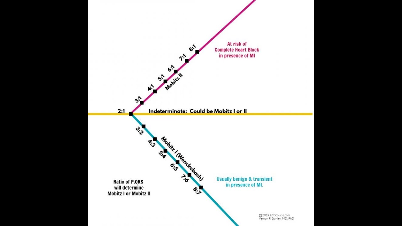 Understanding Mobitz I Versus Mobitz II ECG Rhythm