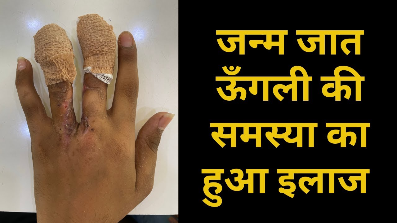 जन्म जात ऊँगली का चिपका होने की समस्या का हुआ निदान | Finger Deformity problem