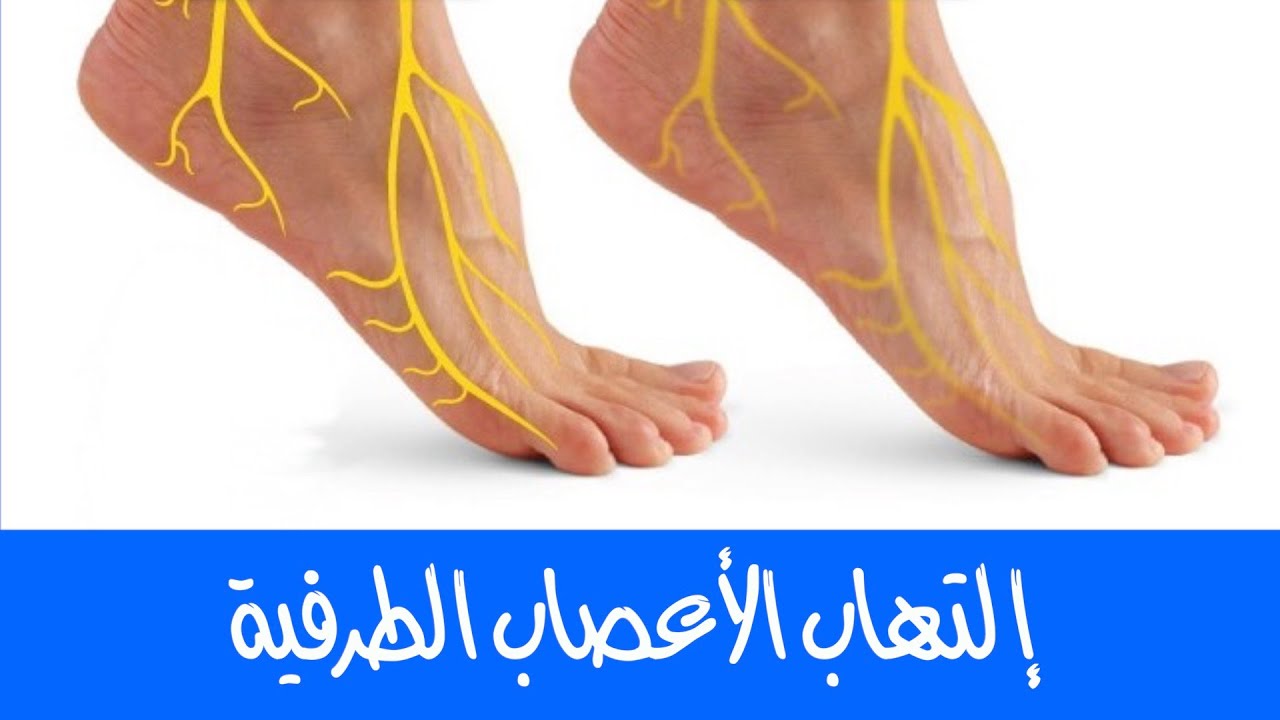 إلتهاب الأعصاب الطرفية | الأسباب، الأعراض، وطرق العلاج