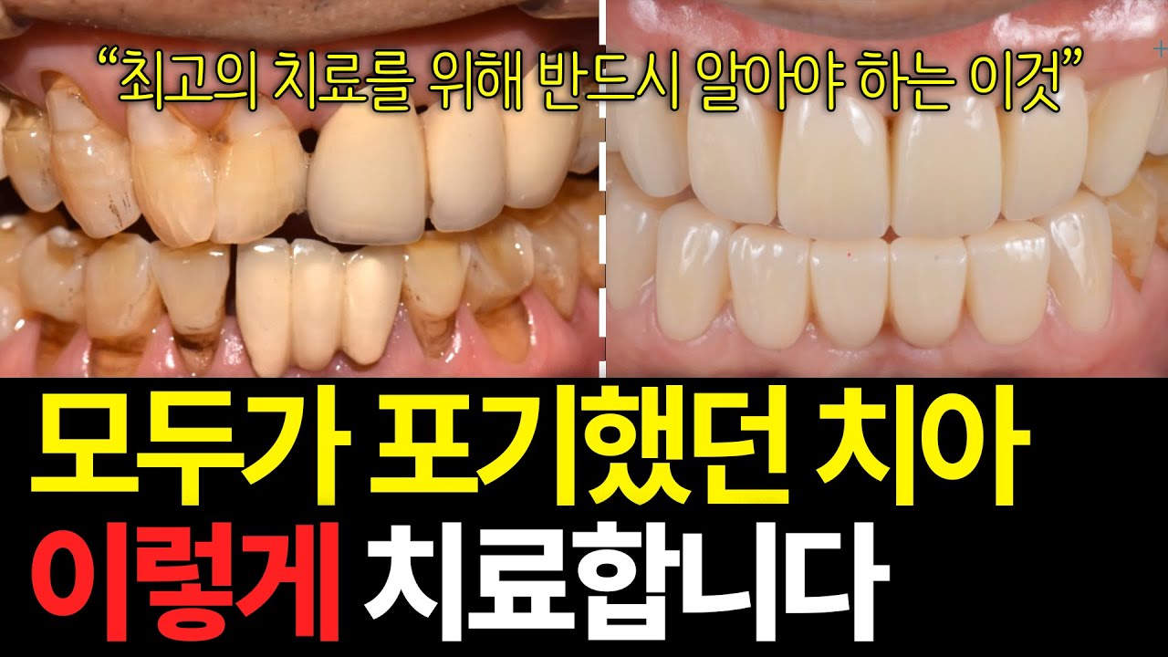 잘 하는 치과의사를 만나야 하는 이유