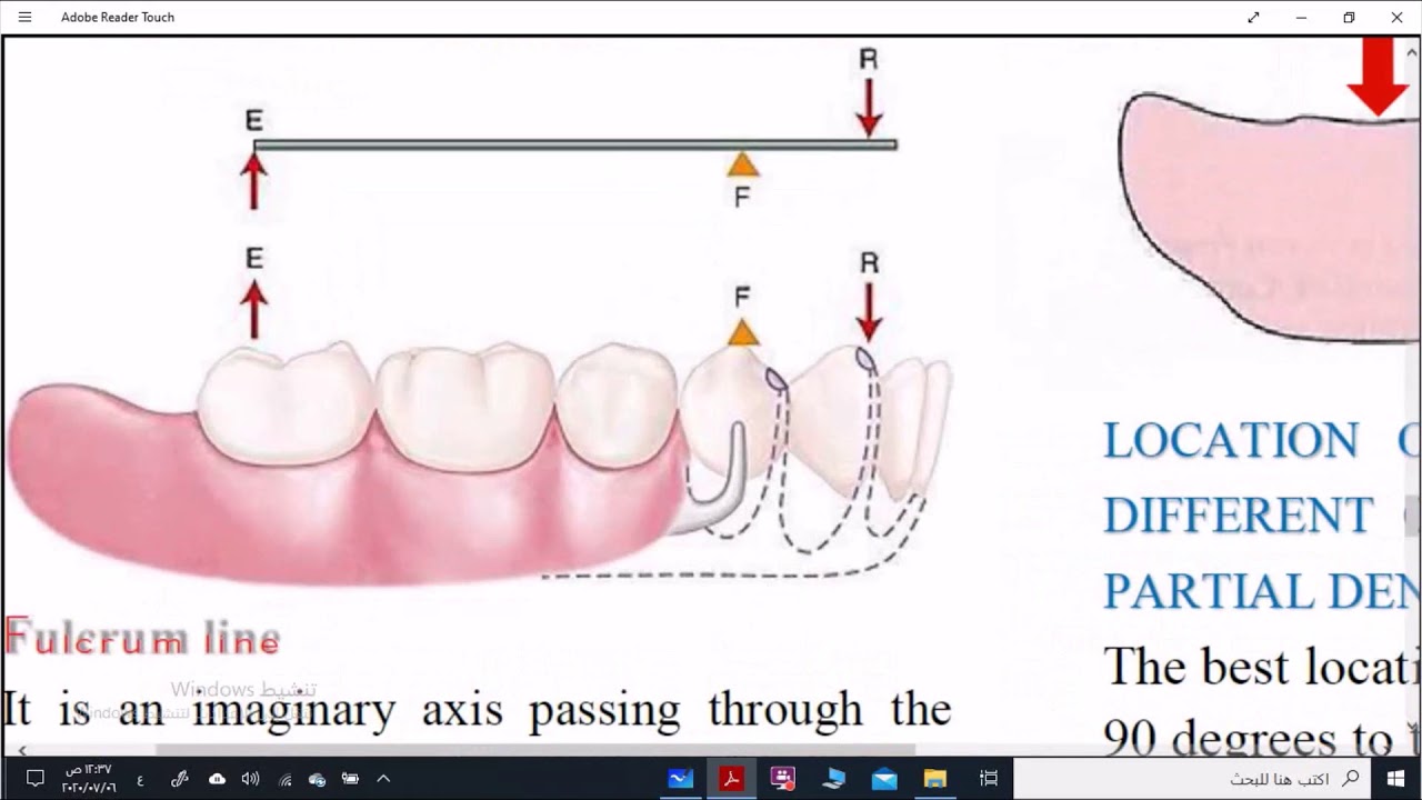 Indirect retainer (part 1)