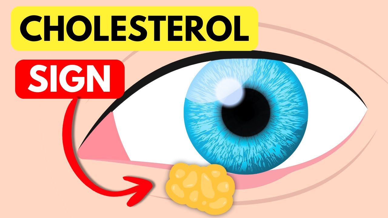 How HIGH Cholesterol Affects The Eyes