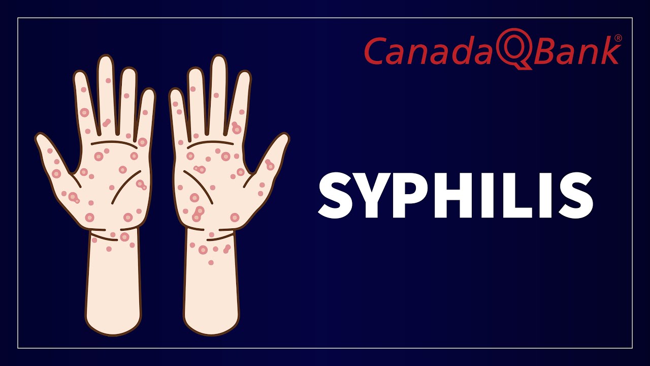 Syphilis: Stages, Diagnosis & Treatment Explained | STI Overview | CanadaQBank