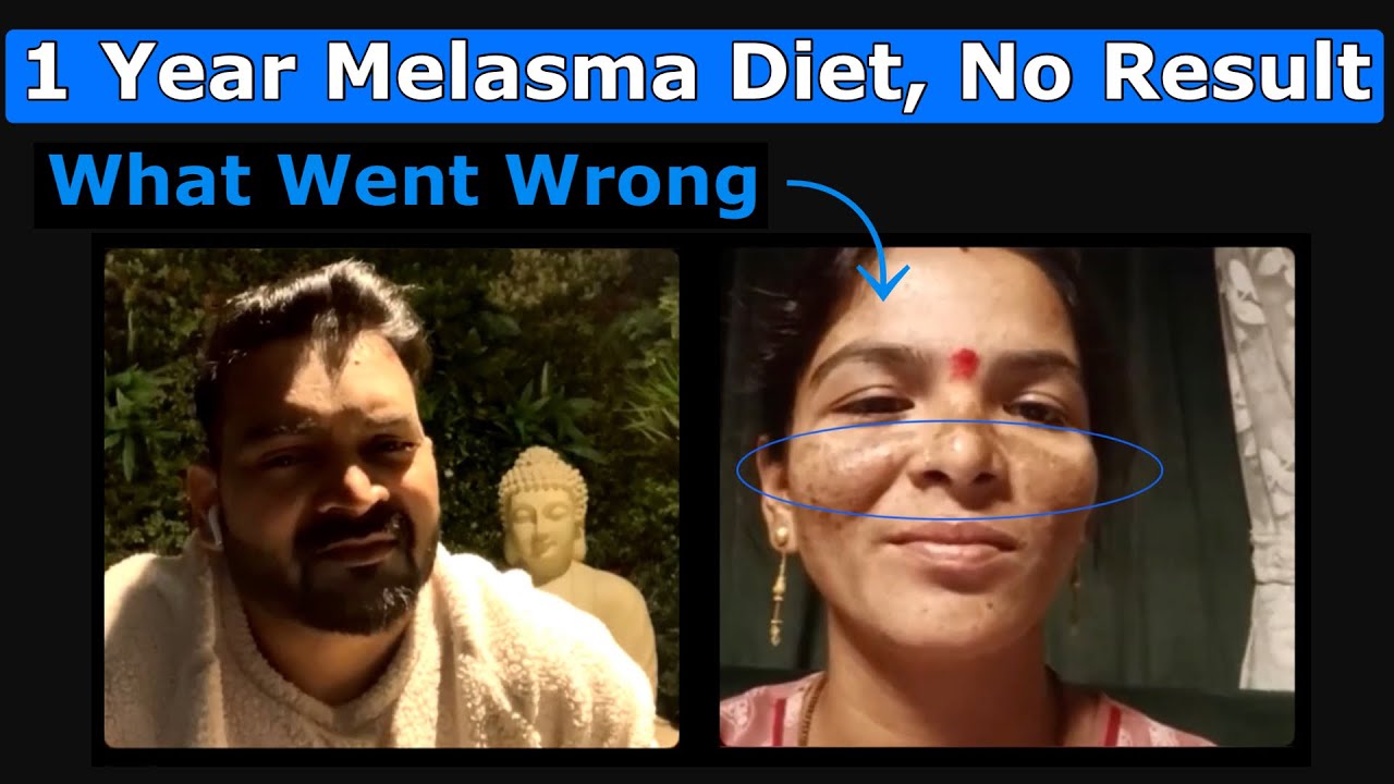 1 Year Melasma Diet But No Result, What went wrong ?