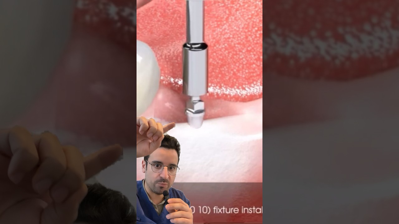 L&rsquo;IMPLANT dentaire et le DENTIER amovible : proth&egrave;se combin&eacute;e