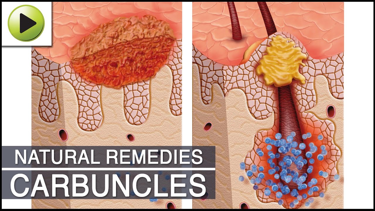 Home Remedies for Carbuncles