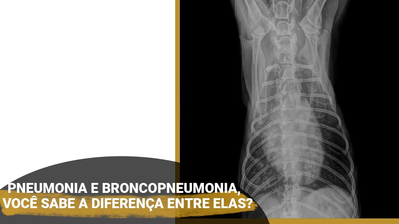 Pneumonia e broncopneumonia, voc&ecirc; sabe a diferen&ccedil;a entre elas?