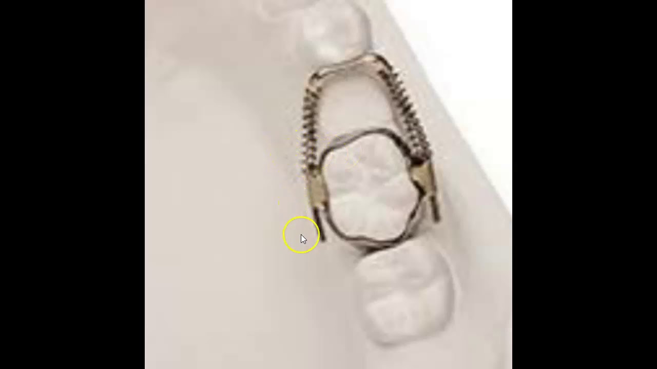 Open Coil Spring Appliance