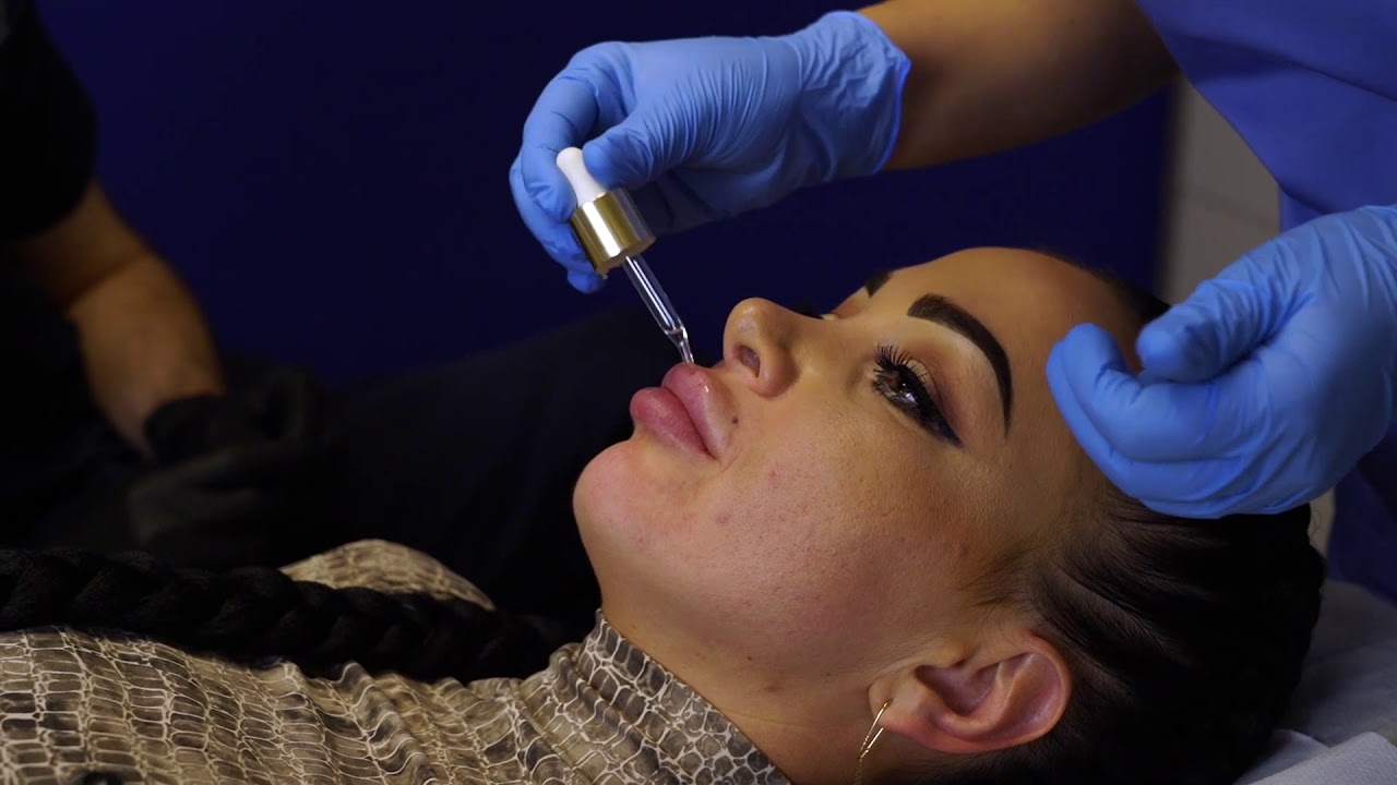 Injectarea de Acid Hialuronic in Buze: Cum Poate fi Corectat un Rezultat Nereusit?