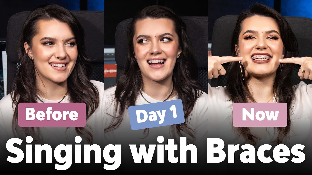 Singing with Braces: Comparing Before, Day 1, and Months Later