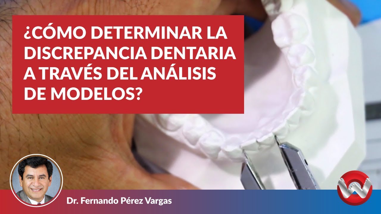 Cómo Determinar la Discrepancia Dentaria a través del Análisis de Modelos II
