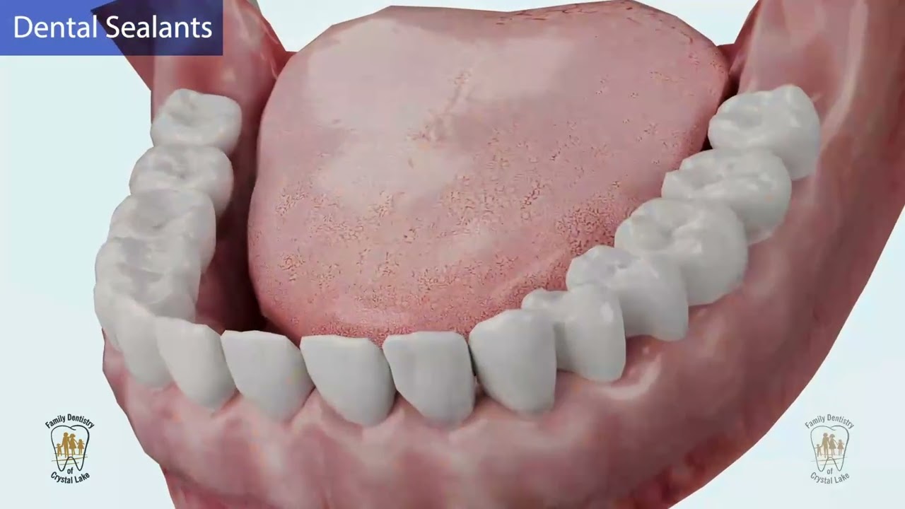 How Dental Sealants Prevent Cavities
