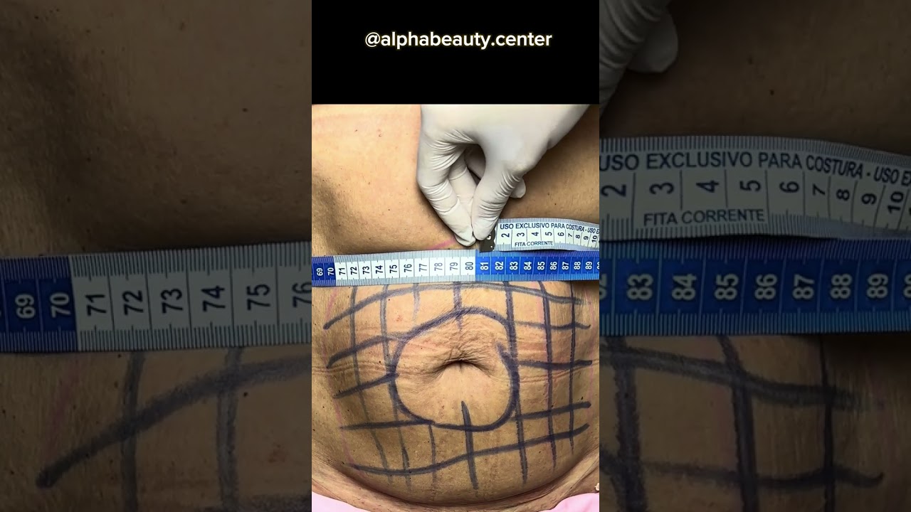 Lipoenzimática com desoxicolato - Tratamento gordura localizada