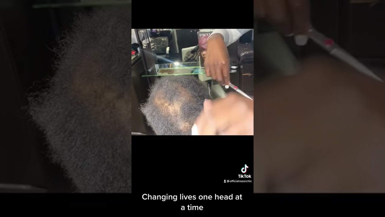 Atlanta HAIRLOSS client.. tour booking visit RAZORCHIC.COM
