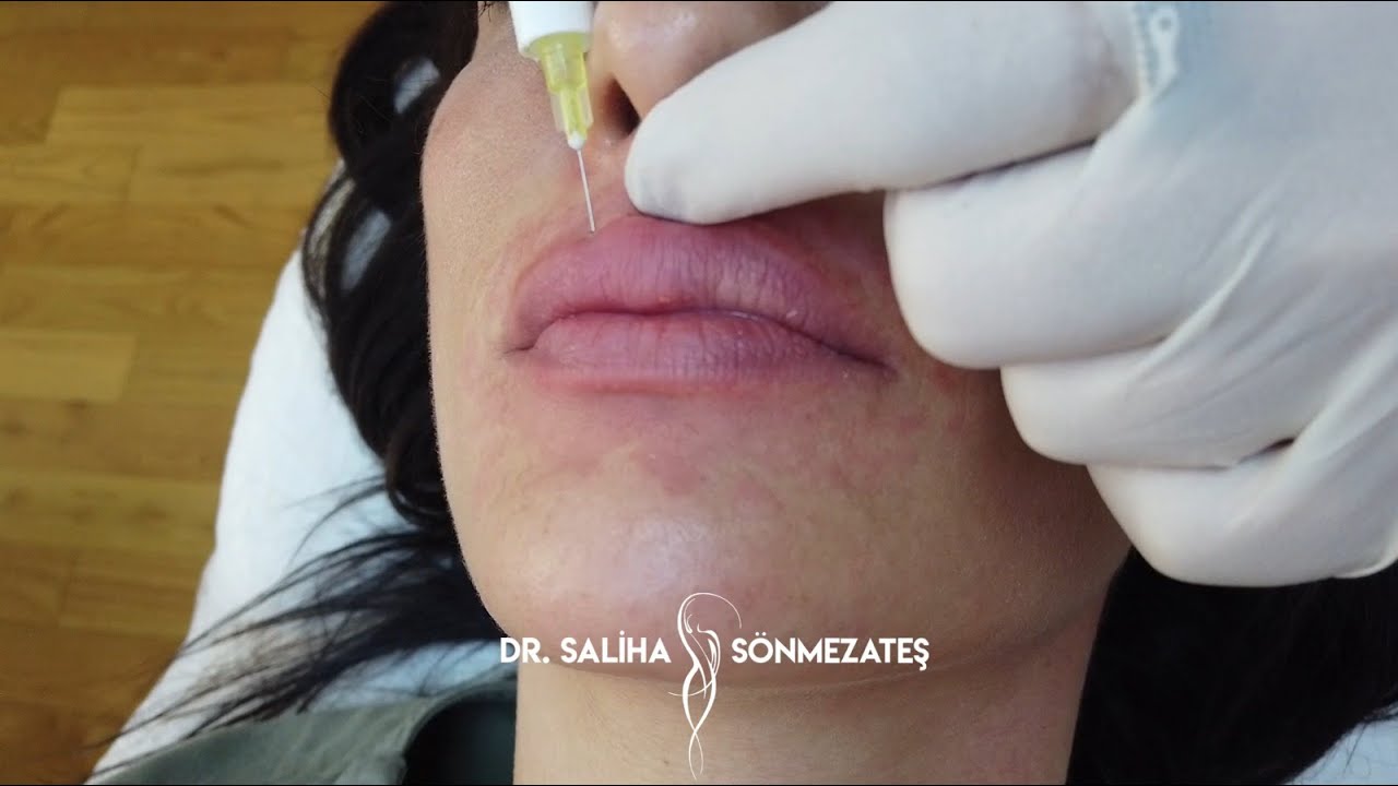 Dudak Dolgusu Nasıl Yapılıyor? I Dr. Saliha SÖNMEZATEŞ