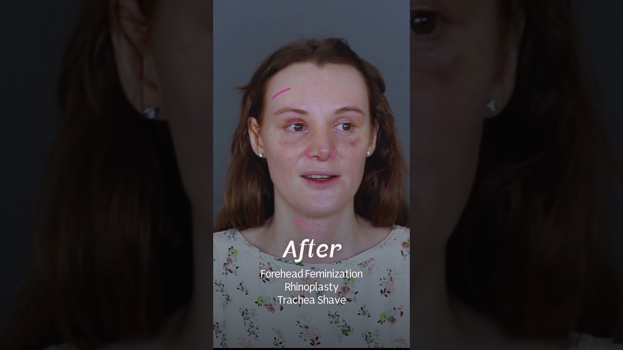 Charlotte, UK &mdash; FFS Before and After