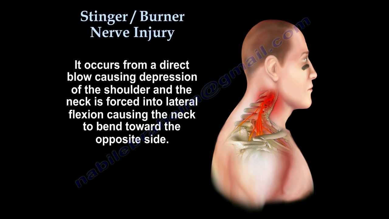 Brachial Plexus ,Stinger Burner Nerve Injury - Everything You Need To Know - Dr. Nabil Ebraheim
