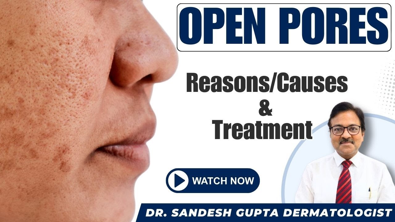 Open pores का सटीक ईलाज। What Should You Avoid? || Dermatologist Dr. Sandesh Gupta