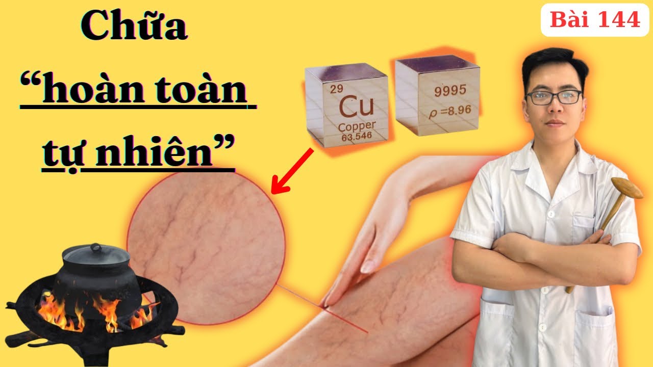 “Suy Giãn Tĩnh Mạch Chi Dưới” - Nguyên Nhân Gốc Rễ, Biến Chứng Nguy Hiểm, Cách Chữa Trị Tự Nhiên