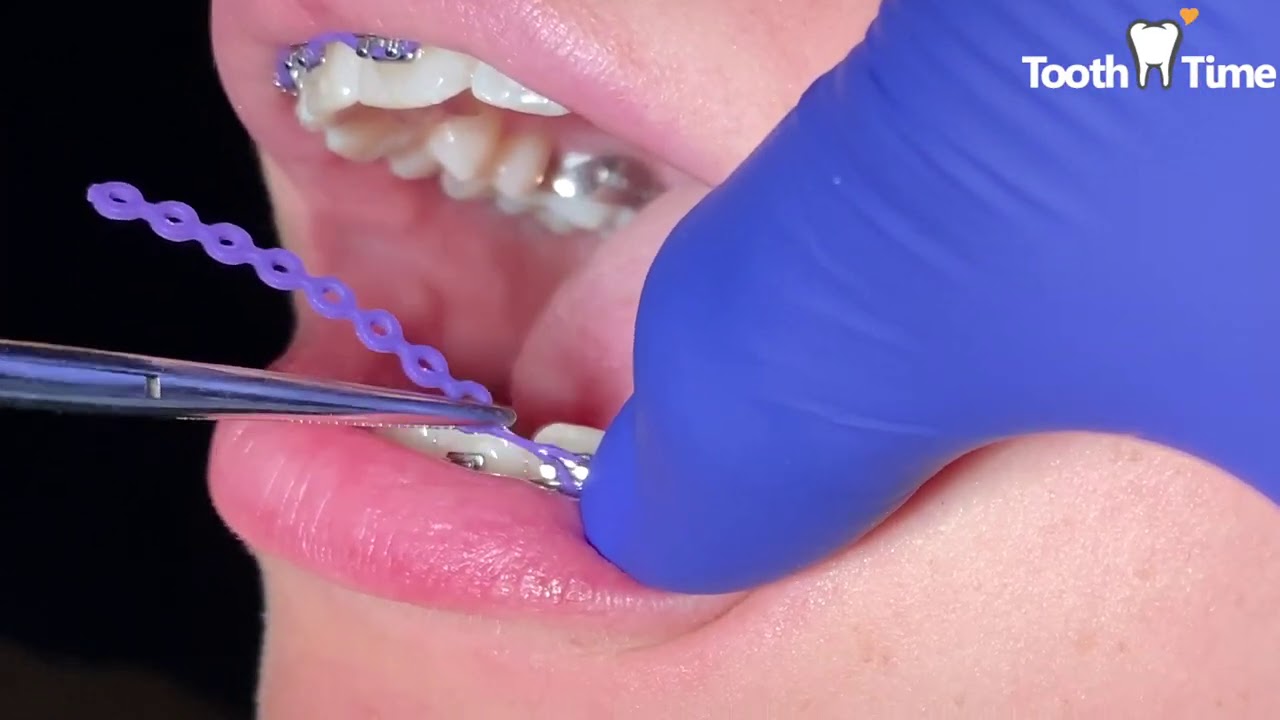 Braces Check up - Changing Power Chains - Tooth Time New Braunfels