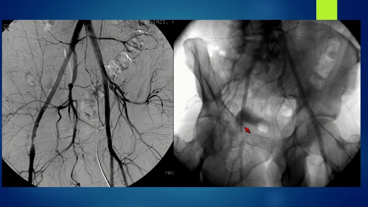 Turbohawk Atherectomy – Why, When, and How? - Khusrow Niazi, MD
