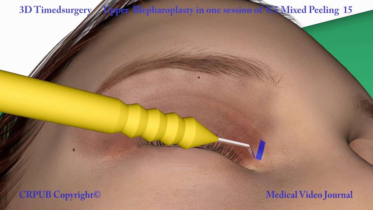 16.Non-surgical upper blepharoplasty in only one session of 0.5 timedsurgical mixed peeling