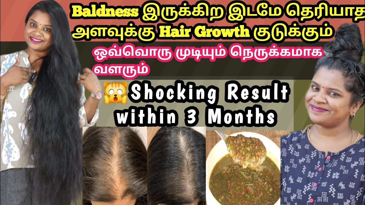 🥰Baldness Hair Regrowth Pack👉 Result within 3 months @Jeswinmeena @Jegatheesmeena
