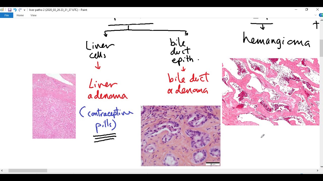 Systemic pathology 76 : Liver tumors   Dr. Sameh Ghazy